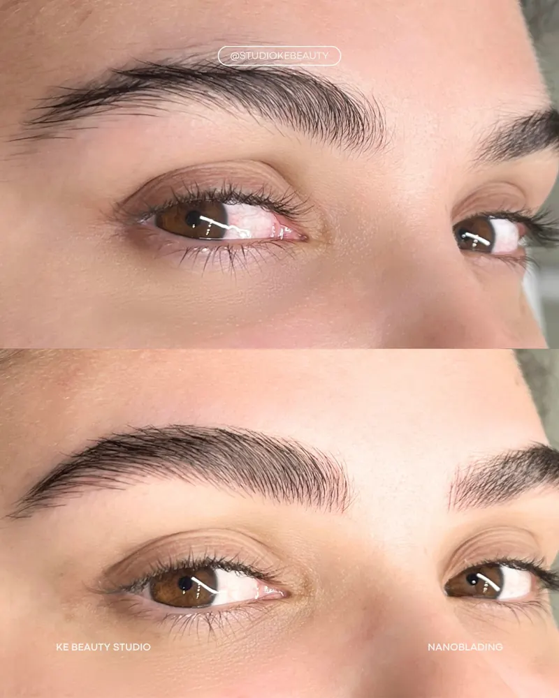 Antes e depois de nanoblading: em cima a sobrancelha com falhas, embaixo preenchida e com mais volume